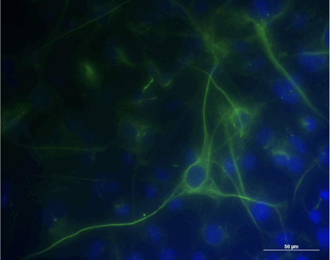 Ovarian cancer cell stained with tubulin